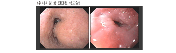 위내시경 상 진단된 식도암 이미지